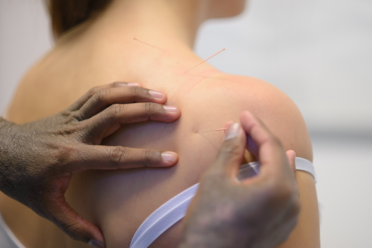 Medicinsk akupunktur